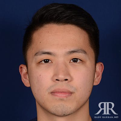 Chin Augmentation Before & After Gallery - Patient 274657 - Image 2