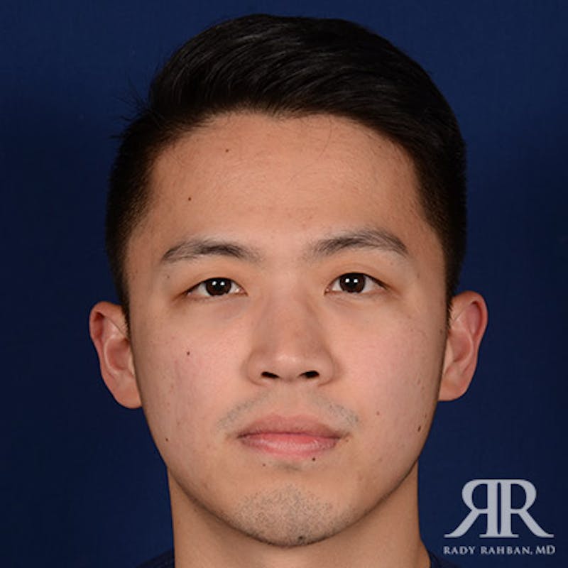 Chin Augmentation Before & After Gallery - Patient 274657 - Image 2