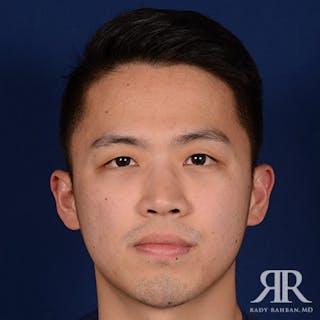 Chin Augmentation Before & After Gallery - Patient 274657 - Image 2