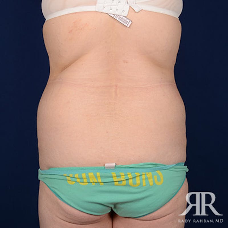 Body Lift Before & After Gallery - Patient 142772 - Image 7
