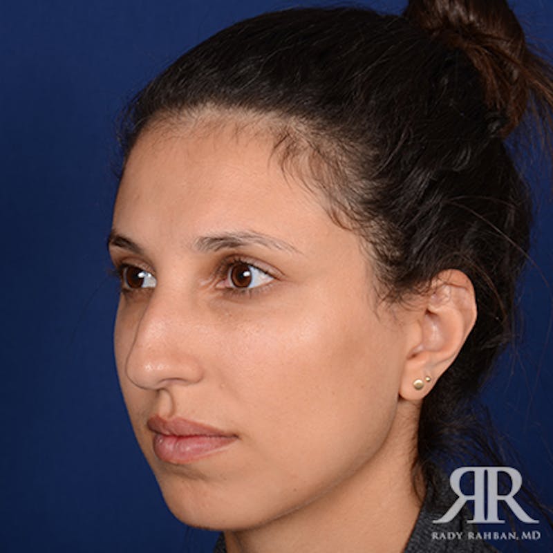 Female Rhinoplasty Before & After Gallery - Patient 180163 - Image 3