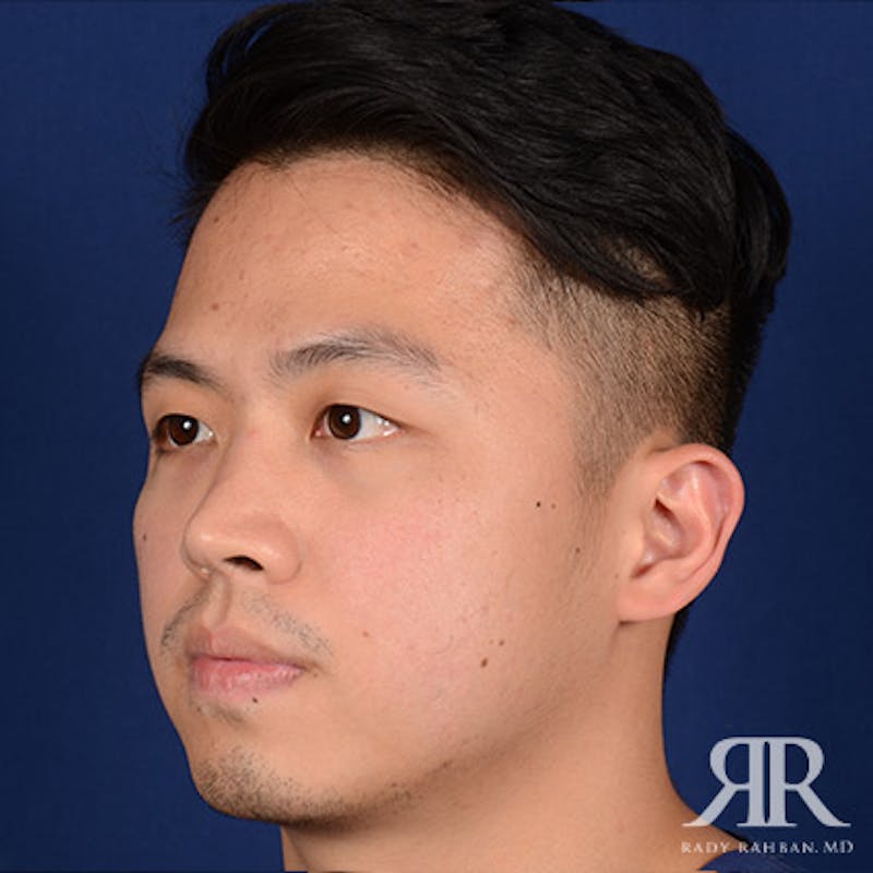 Chin Augmentation Before & After Gallery - Patient 274657 - Image 3