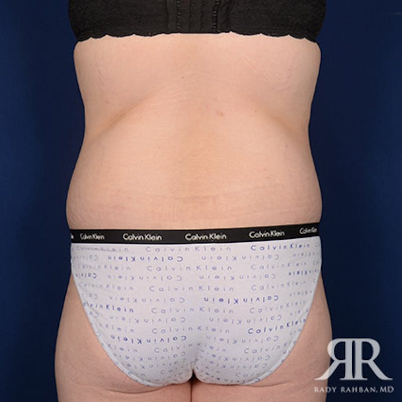 Body Lift Before & After Gallery - Patient 142772 - Image 8