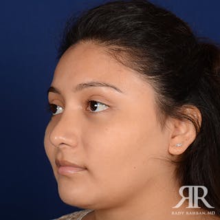 Rhinoplasty w/ Chin Implant Before & After Gallery - Patient 450967 - Image 4