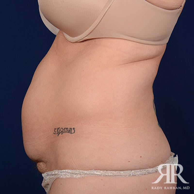 Severe Diastasis Recti Before & After Gallery - Patient 378045 - Image 5