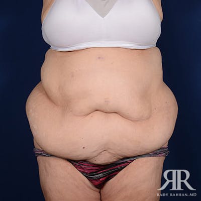 Body Lift Before & After Gallery - Patient 255804 - Image 1