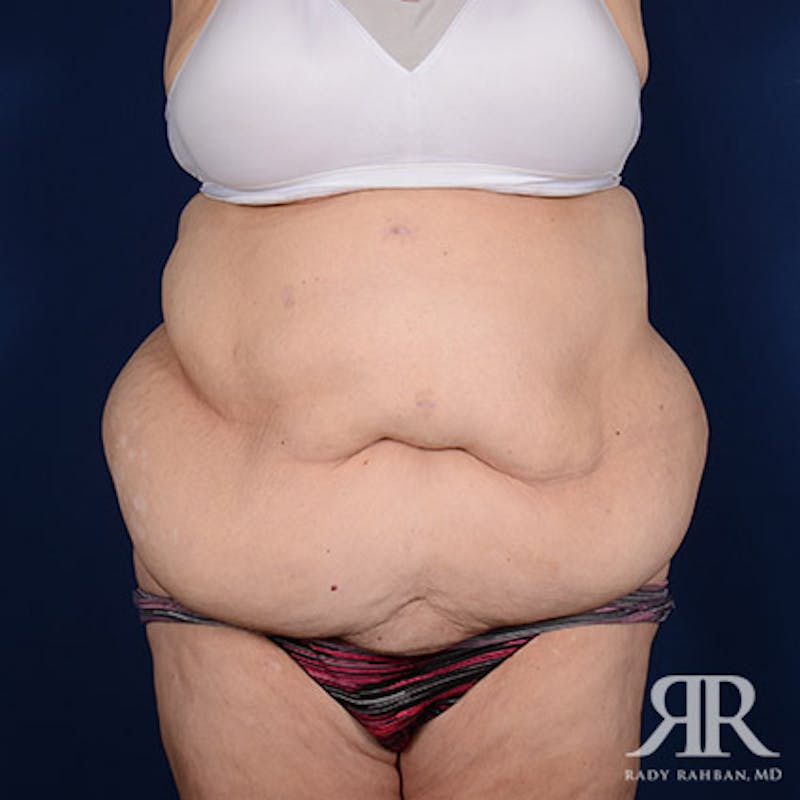 Body Lift Before & After Gallery - Patient 255804 - Image 1