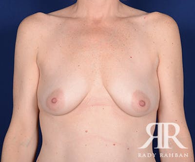 Breast Lift Before & After Gallery - Patient 181425 - Image 1