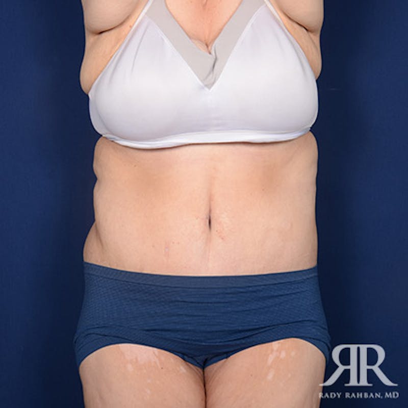Body Lift Before & After Gallery - Patient 255804 - Image 2