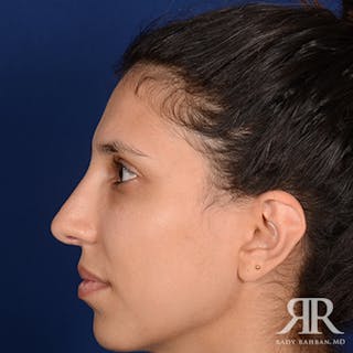 Female Rhinoplasty Before & After Gallery - Patient 180163 - Image 6
