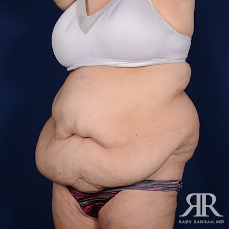 Body Lift Before & After Gallery - Patient 255804 - Image 3