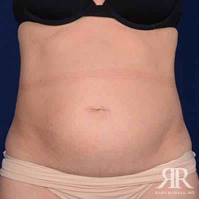 Severe Diastasis Recti Before & After Gallery - Patient 168335 - Image 1
