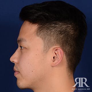 Chin Augmentation Before & After Gallery - Patient 274657 - Image 6
