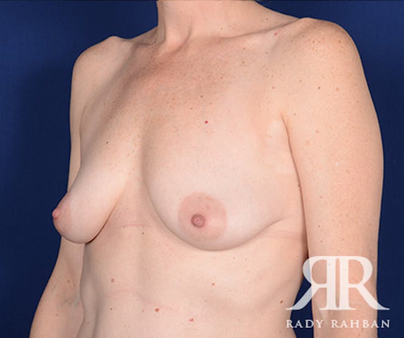 Breast Lift Before & After Gallery - Patient 181425 - Image 3