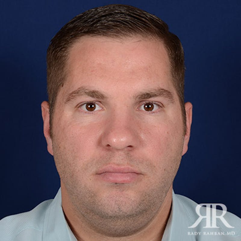 Rhinoplasty w/ Chin Implant Before & After Gallery - Patient 119344 - Image 1