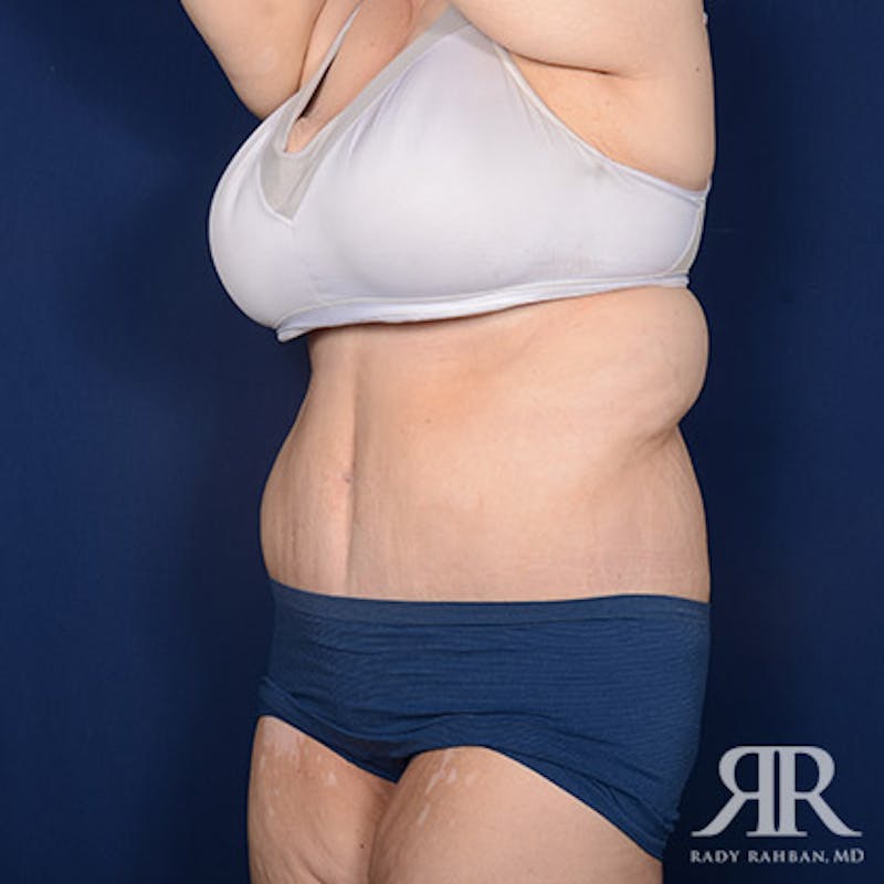 Body Lift Before & After Gallery - Patient 255804 - Image 4