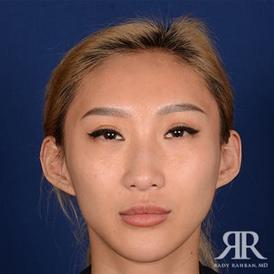 Female Rhinoplasty Before & After Gallery - Patient 247322 - Image 1