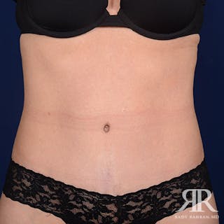 Severe Diastasis Recti Before & After Gallery - Patient 168335 - Image 2