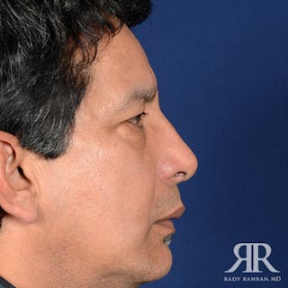 Ethnic Rhinoplasty Before & After Gallery - Patient 179352 - Image 6