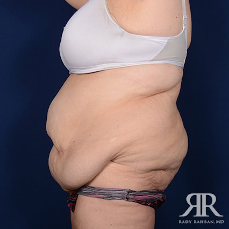 Body Lift Before & After Gallery - Patient 255804 - Image 5