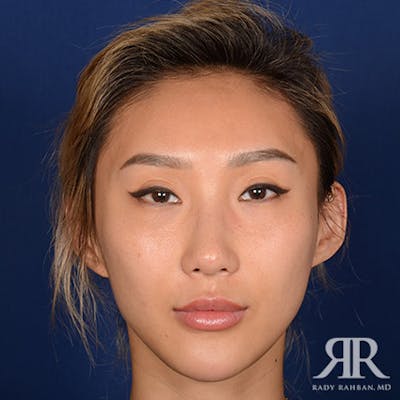 Female Rhinoplasty Before & After Gallery - Patient 247322 - Image 2