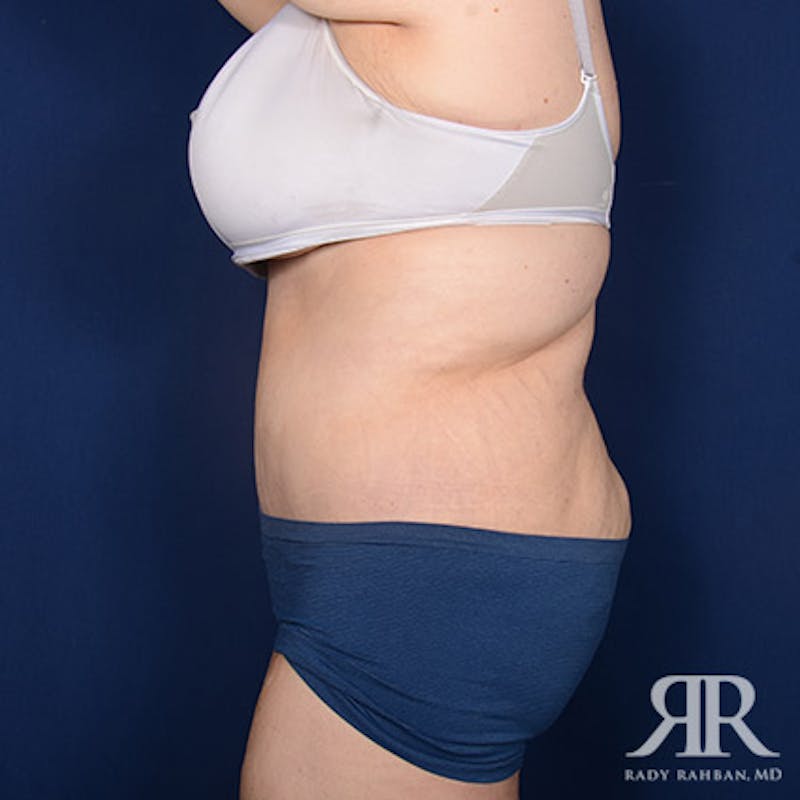 Body Lift Before & After Gallery - Patient 255804 - Image 6