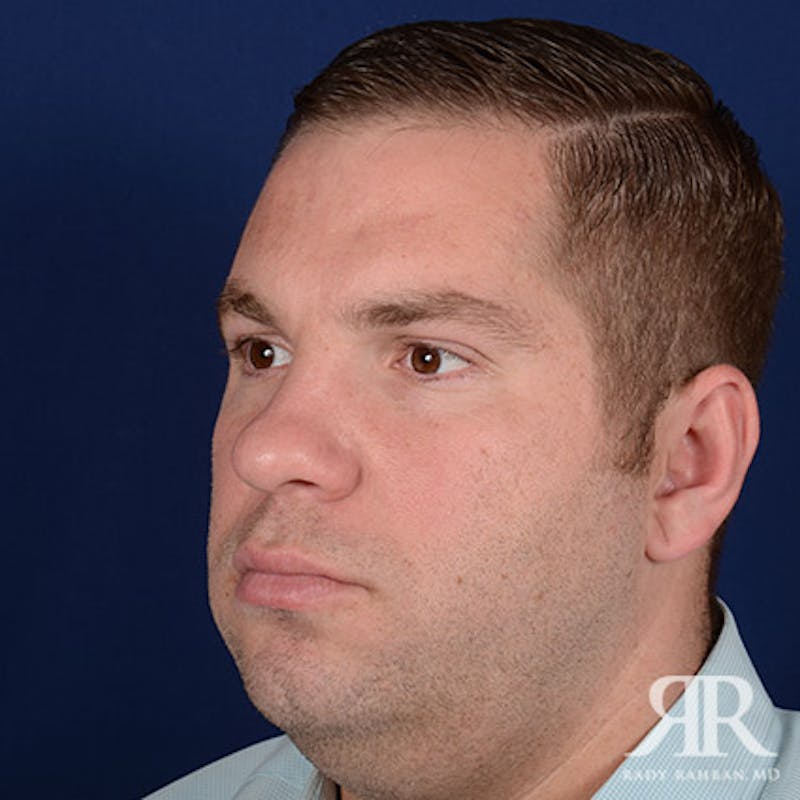 Rhinoplasty w/ Chin Implant Before & After Gallery - Patient 119344 - Image 3