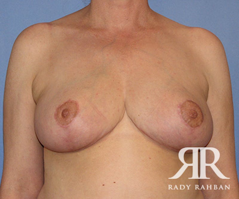 Breast Reduction Before & After Gallery - Patient 107654 - Image 2
