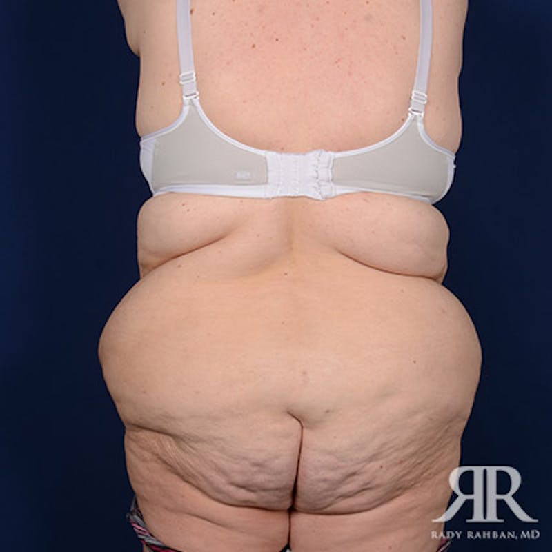 Body Lift Before & After Gallery - Patient 255804 - Image 7