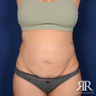 Tummy Tuck Before & After Gallery - Patient 380216 - Image 1