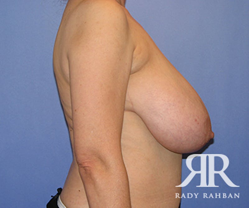 Breast Reduction Before & After Gallery - Patient 107654 - Image 3