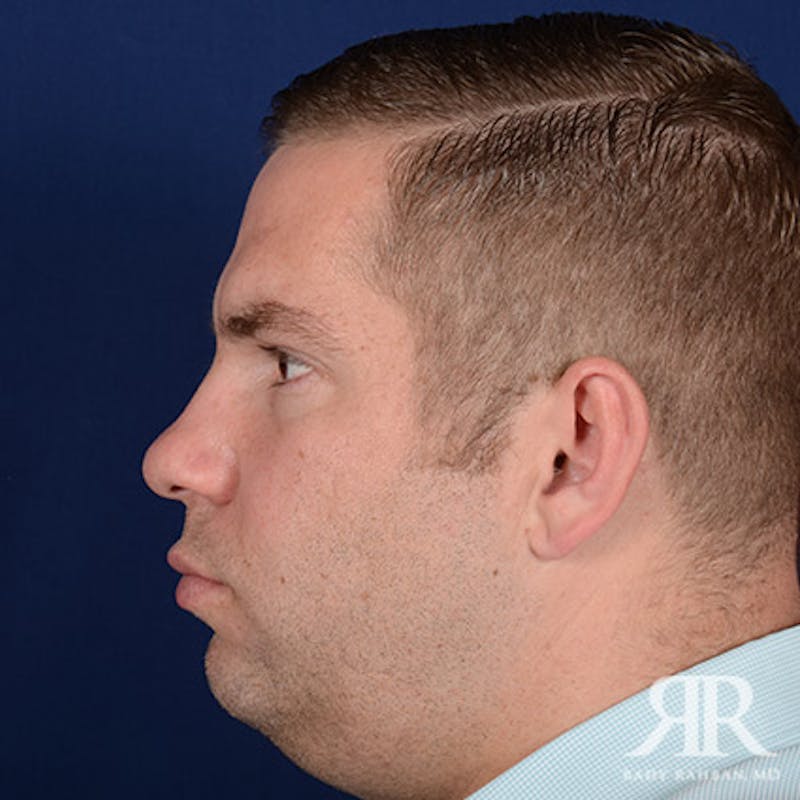 Rhinoplasty w/ Chin Implant Before & After Gallery - Patient 119344 - Image 5