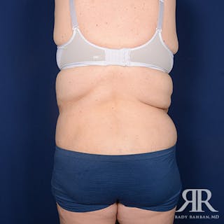 Body Lift Before & After Gallery - Patient 255804 - Image 8