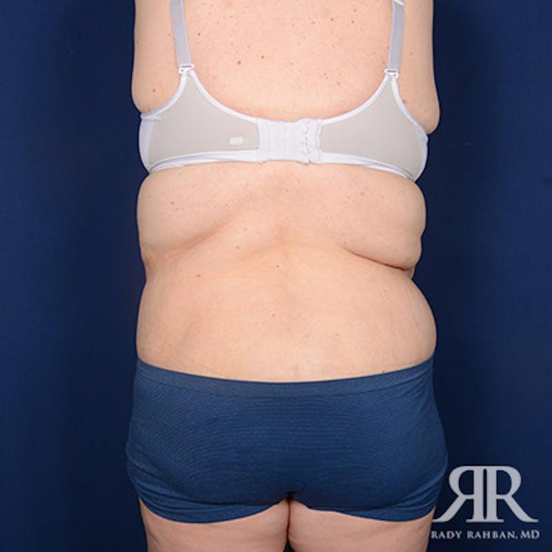 Body Lift Before & After Gallery - Patient 255804 - Image 8