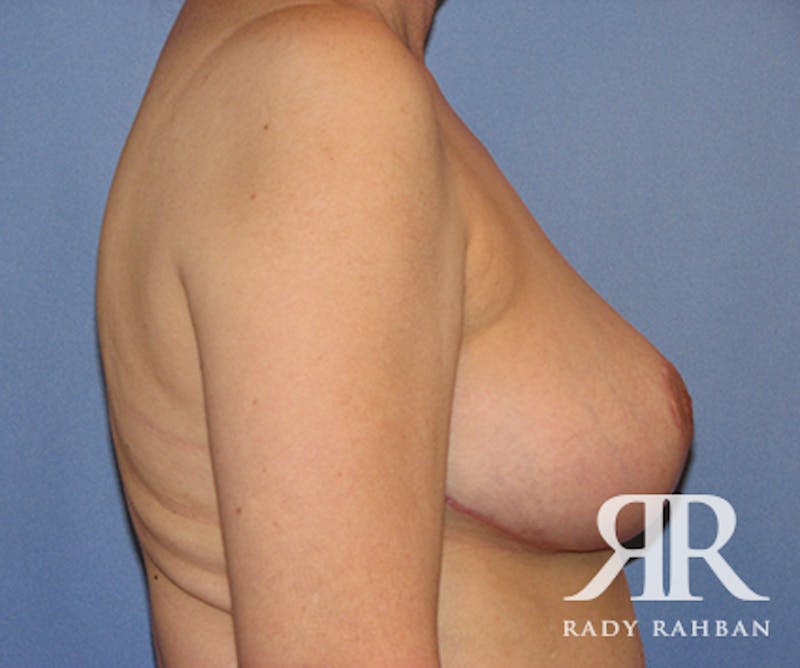 Breast Reduction Before & After Gallery - Patient 107654 - Image 4
