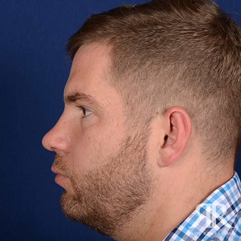 Rhinoplasty w/ Chin Implant Before & After Gallery - Patient 119344 - Image 6
