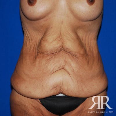 Body Lift Before & After Gallery - Patient 247388 - Image 1
