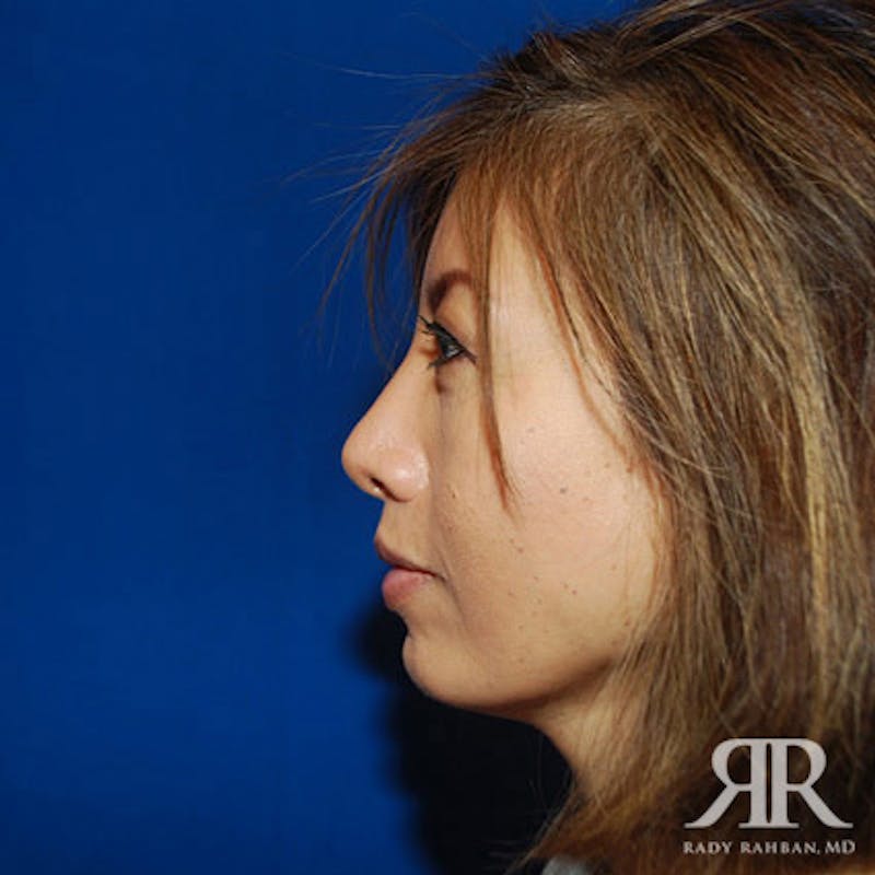 Chin Augmentation Before & After Gallery - Patient 104281 - Image 6