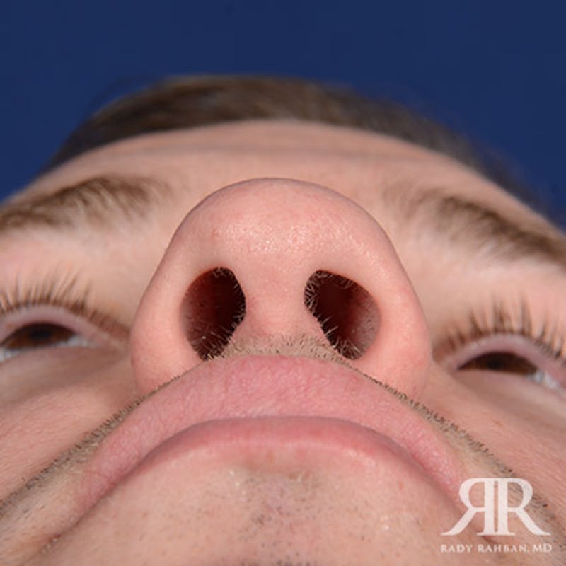 Rhinoplasty w/ Chin Implant Before & After Gallery - Patient 119344 - Image 7