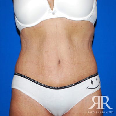 Body Lift Before & After Gallery - Patient 247388 - Image 2