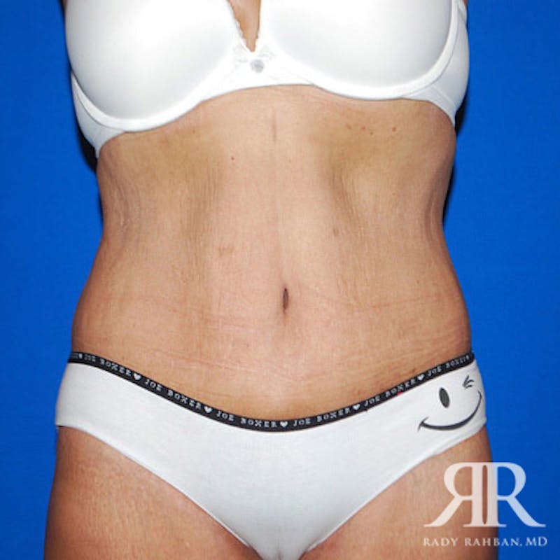 Body Lift Before & After Gallery - Patient 247388 - Image 2