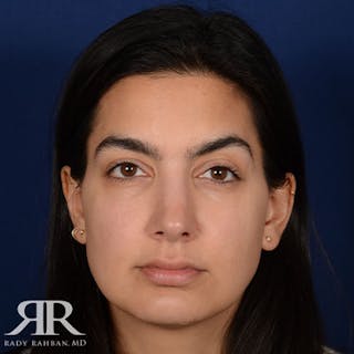 Female Rhinoplasty Before & After Gallery - Patient 329574 - Image 2