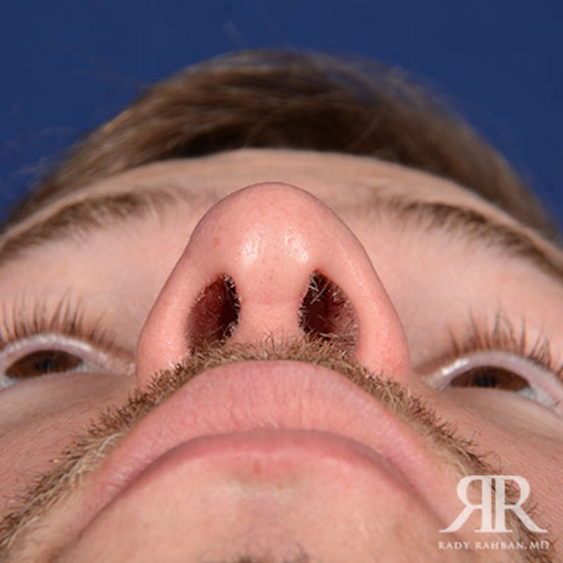 Rhinoplasty w/ Chin Implant Before & After Gallery - Patient 119344 - Image 8