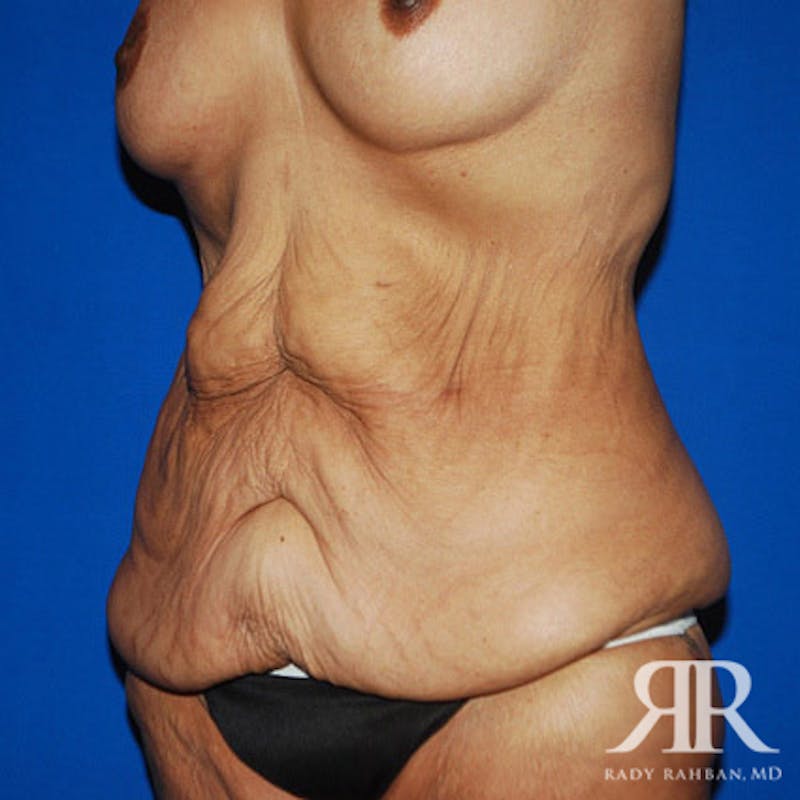 Body Lift Before & After Gallery - Patient 247388 - Image 3