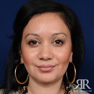 Chin Augmentation Before & After Gallery - Patient 371886 - Image 2