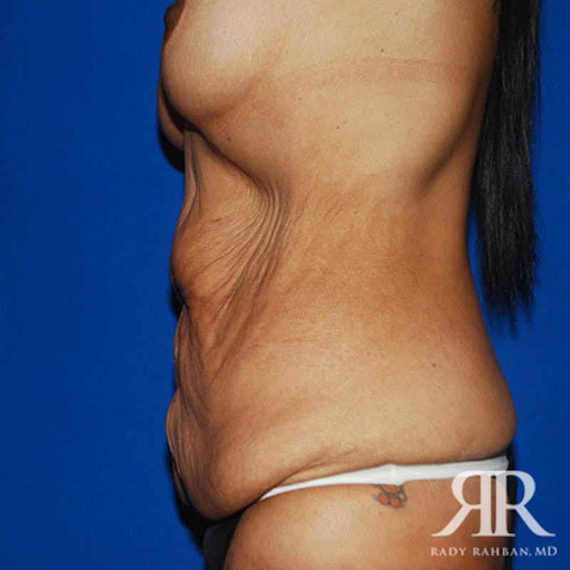 Body Lift Before & After Gallery - Patient 247388 - Image 5