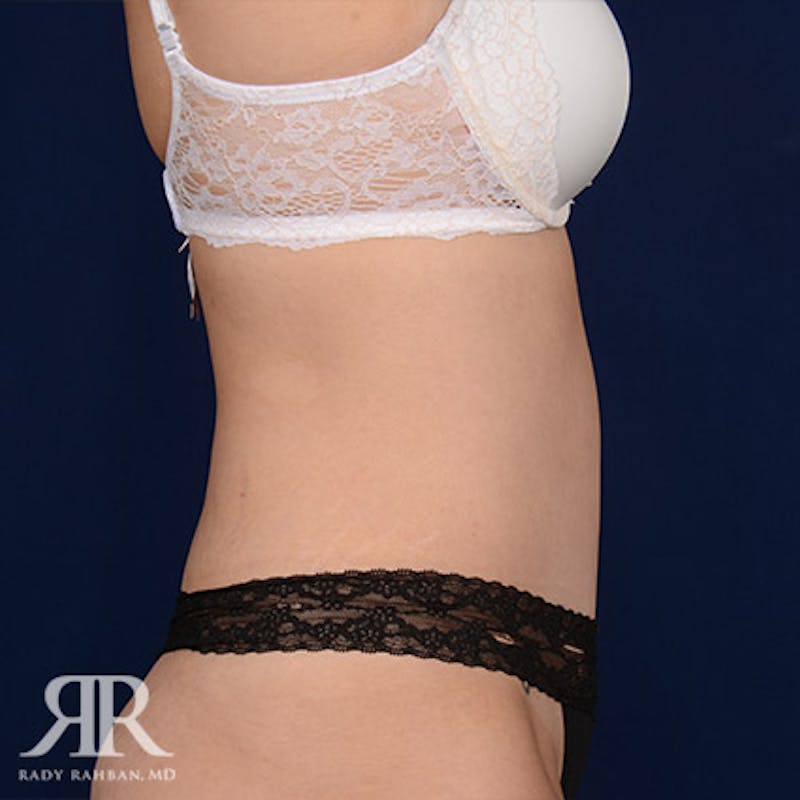Severe Diastasis Recti Before & After Gallery - Patient 101187 - Image 6