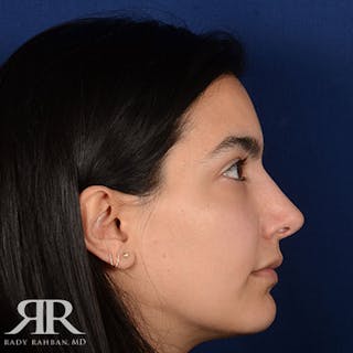 Female Rhinoplasty Before & After Gallery - Patient 329574 - Image 6