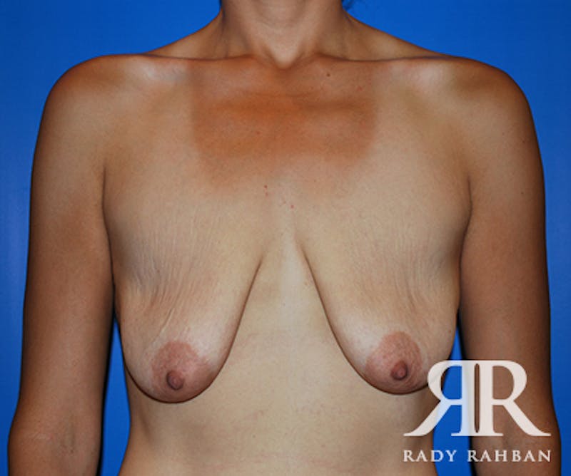 Breast Lift Before & After Gallery - Patient 238682 - Image 1