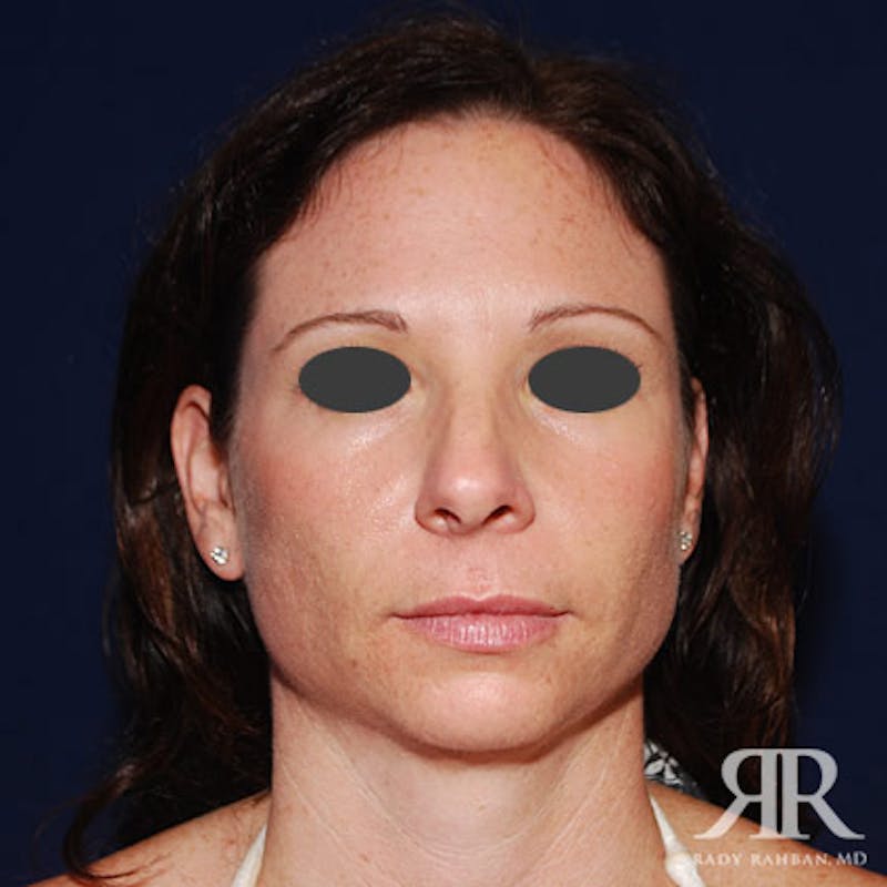 Chin Augmentation Before & After Gallery - Patient 278151 - Image 1